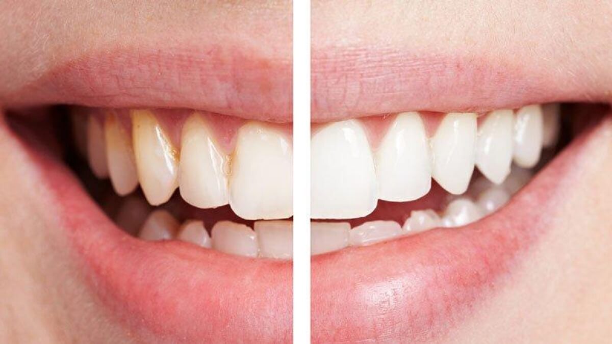 Evde karbonatla diş beyazlatma nasıl yapılır